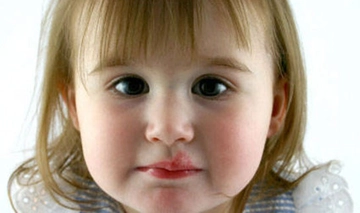 Bebeklerde Uçuk Belirtileri ve Tedavisi